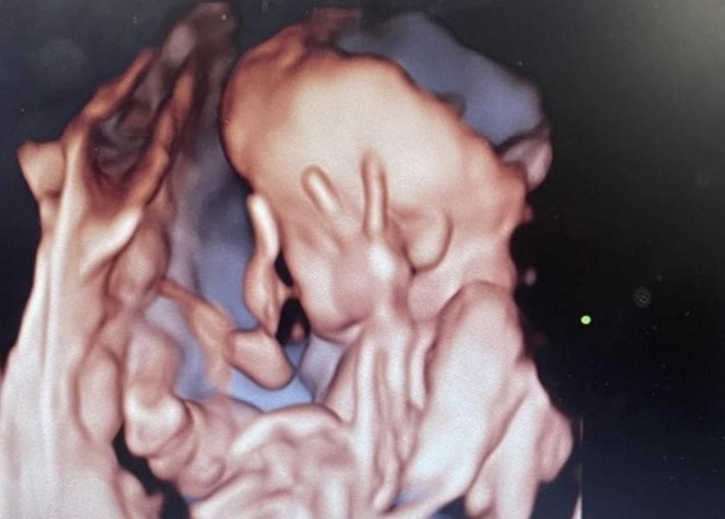 Maddy Lundstrams, 20, baby girl stuck two fingers up at her during a private 25 week scan.